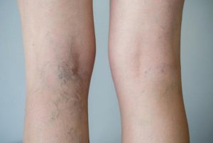 leg-vein-treatment