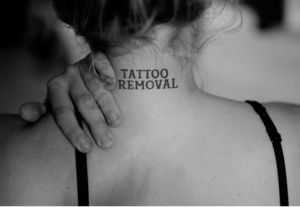 Laser Tattoo Removal The Aesthetic Clinic