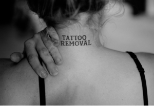 Laser Tattoo Removal