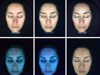 Photo Rejuvenation Treatment