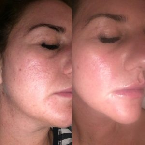 dermapen-treatment-acne-scarring