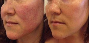 rosacea-treatment