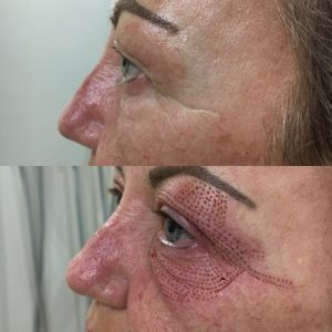 plasma patient b&a