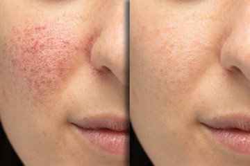 Acne Therapy treatment at The Aesthetic Clinic, Ormskirk