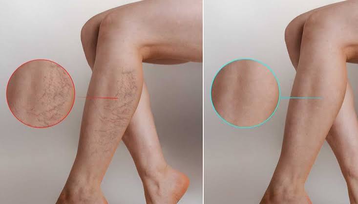 Leg & Facial Veins treatment at The Aesthetic Clinic, Ormskirk