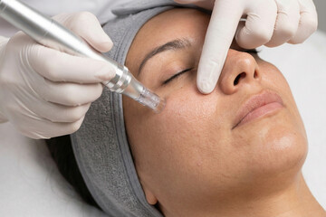 Medical Microneedling treatment at The Aesthetic Clinic, Ormskirk